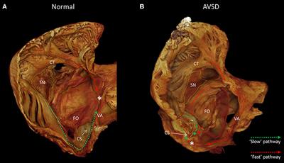 Morphological Substrates for Atrial Arrhythmogenesis in a Heart With Atrioventricular Septal Defect